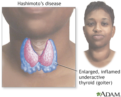 Thyroid Gland Swollen