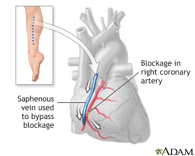 What is heart bypass surgery?