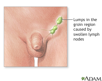 Swollen Lymph Nodes Symptoms & Treatment