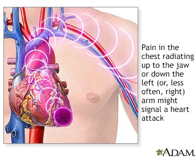 Heart attack pain in left arm symptoms