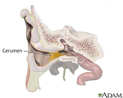 Wax blockage in the ear