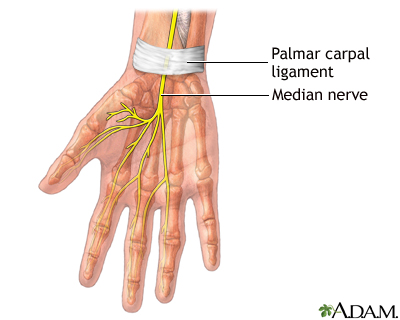 Carpal tunnel repair - Series