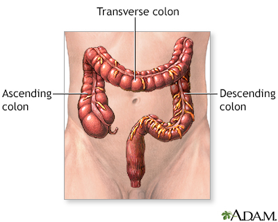 Large bowel resection - Series