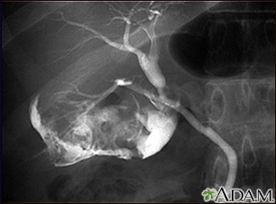 Cholecystitis - cholangiogram