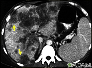 Hepatocellular cancer - CT scan