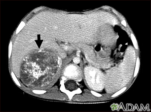 Neuroblastoma in the liver - CT scan