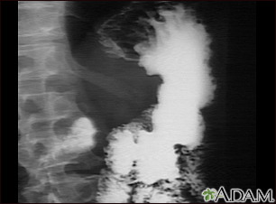 Stomach cancer, X-ray