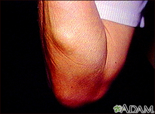 Lipoma - arm