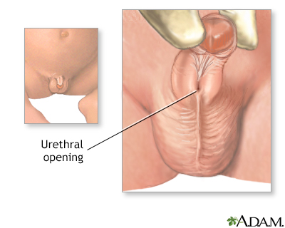 Hypospadias - Indications