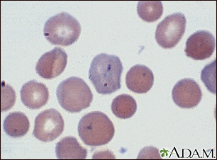 Malaria, microscopic view of cellular parasites