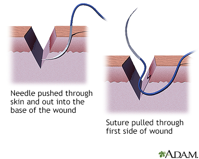 Sewing a wound closed, part 2