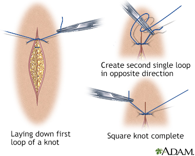 Sewing a wound closed, part 6