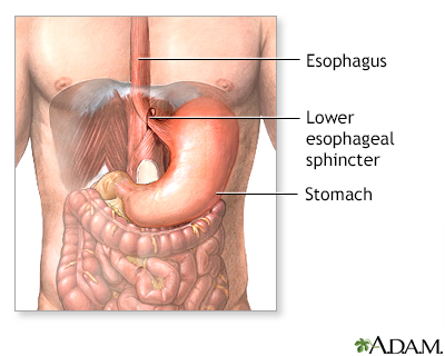 Gastroesophageal reflux - series