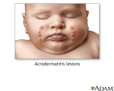 Acrodermatitis