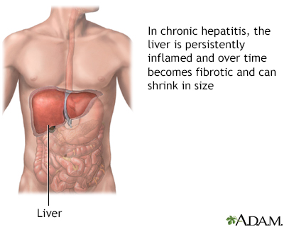 Chronic hepatitis