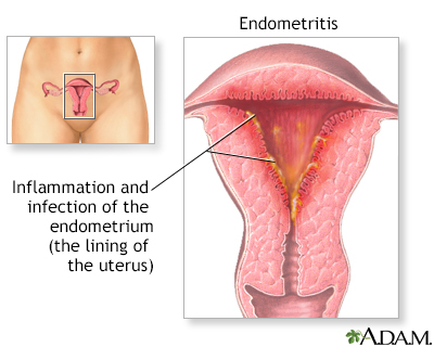 Endometritis