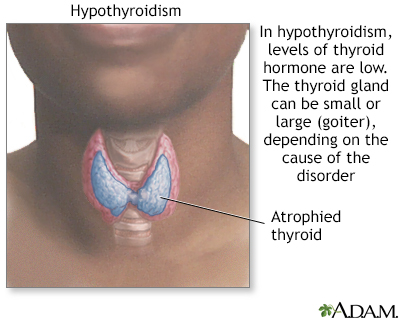 Hypothyroidism