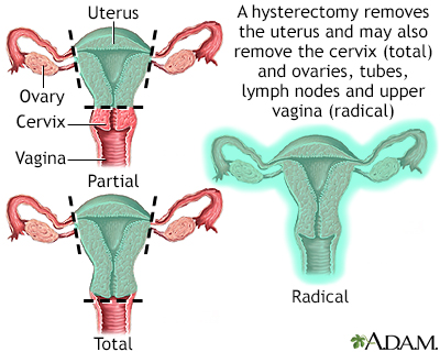 Hysterectomy