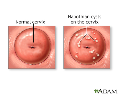 Nabothian cyst