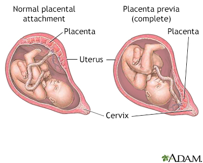 Placenta previa