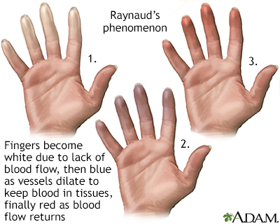 Raynaud's phenomenon