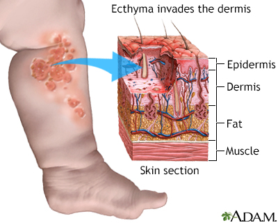 Ecthyma