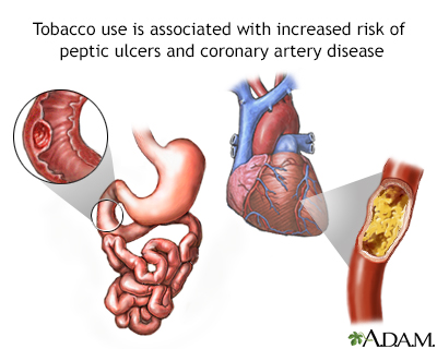 Tobacco and vascular disease