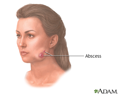 Actinomycosis (lumpy jaw)