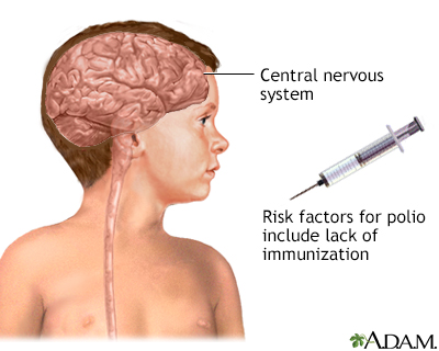 Poliomyelitis