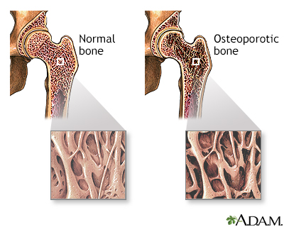 Osteoporosis