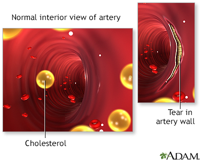 Blockage in internal carotid artery