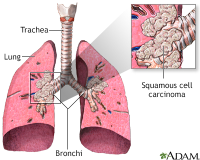 Squamous cell carcinoma