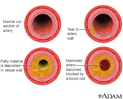 Proceso de evolución de la aterosclerosis