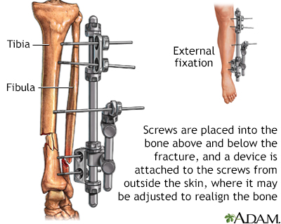 External fixation device