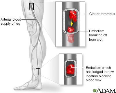 Arterial embolism