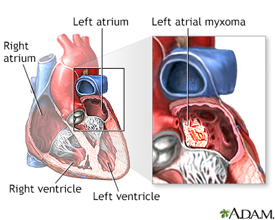 Left atrial myxoma