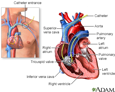 Swan Ganz catheterization