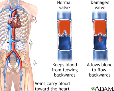 Venous insufficiency