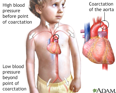 Coarctation of the aorta