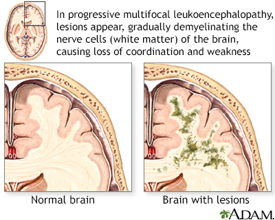 Leukoencephalopathy