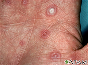 Erythema multiforme, target lesions on the palm