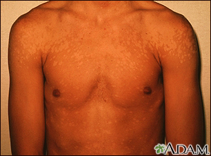 Tinea versicolor - shoulders