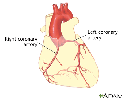 Coronary artery balloon angioplasty - Series