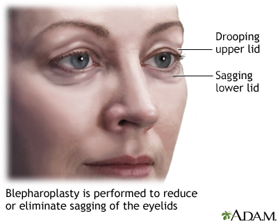 Blepharoplasty - series