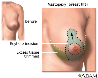 Incisions