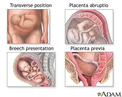 C-Section