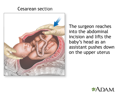 C-Section