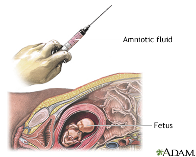 Amniocentesis