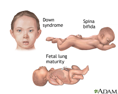 Amniocentesis