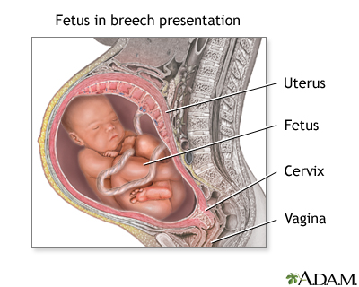 Breech presentation